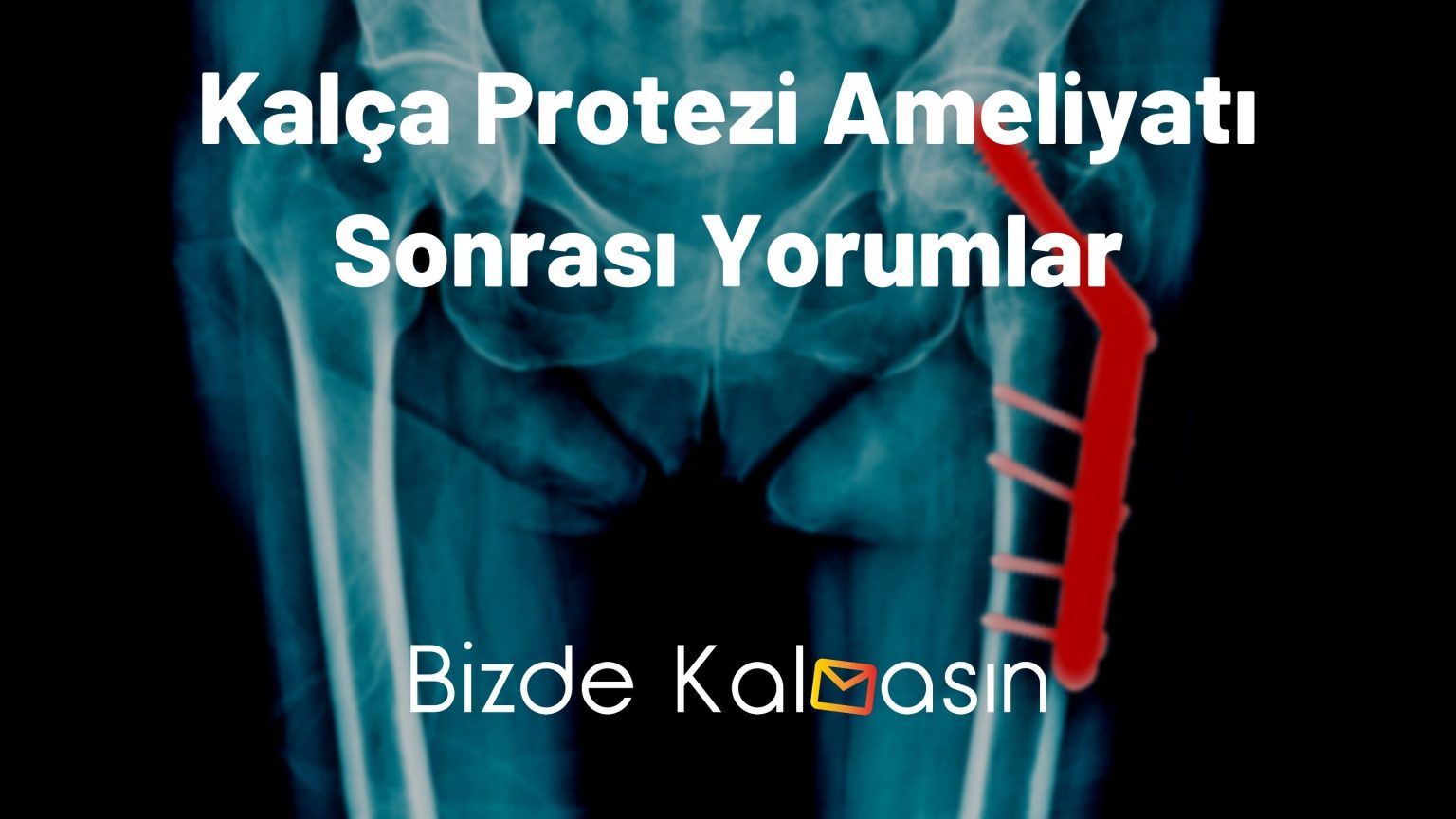 Kal A Protezi Ameliyat Fiyat Ameliyat Sonras Yorumlar